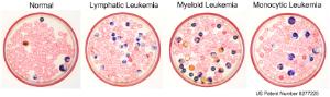 Leukemia Petriscope Set