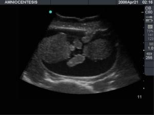 Amniocentesis ultrasound training model