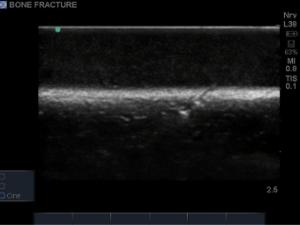 Bone fracture ultrasound training block model with greenstick fractures