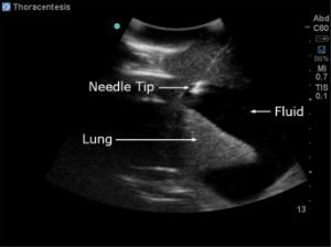 Chest tube/ultrasound guided thoracentesis model