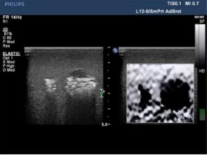 Elastography ultrasound breast phantom
