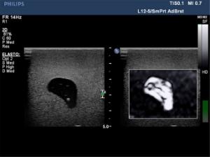 Elastography ultrasound breast phantom