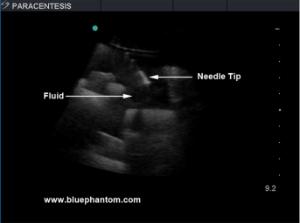 Paracentesis µltrasound training module for µltrasound guided paracentesis