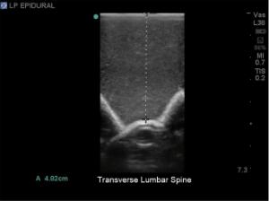 Spinal epidural and lumbar puncture training model