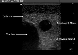 Thyroid biopsy µltrasound training model