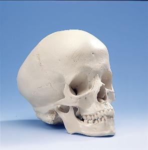 3B Scientific® Hydrocephalic Skull