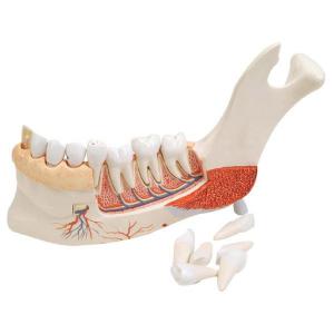 3B Scientific® Advanced Half Lower Jaw With 8 Diseased Teeth