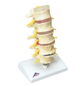 3B Scientific® Stages of Disc Prolapse and Vertebral Degeneration