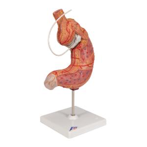 Gastric Band Model