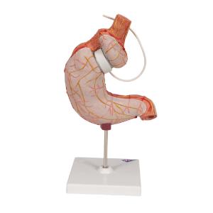 Gastric Band Model