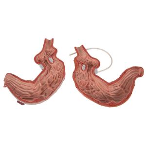 Gastric Band Model