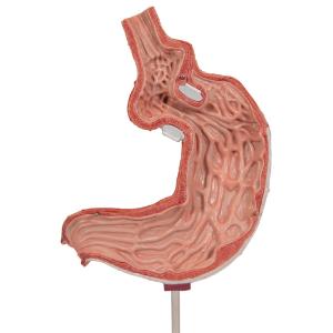 Gastric Band Model