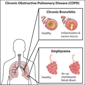 Science Take-Out® Lung Disease