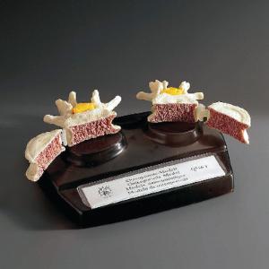 Somso® Osteoporosis Model