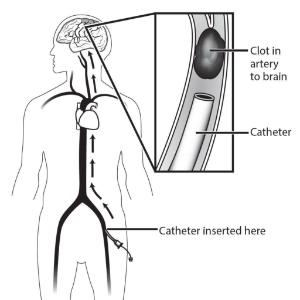 Science Take-Out® Testing A Clot Buster