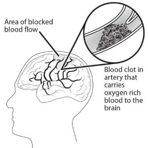 Science Take-Out® Testing A Clot Buster