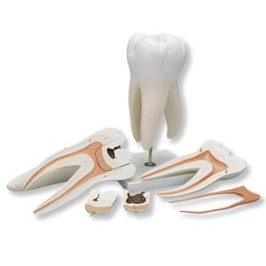 3B Scientific® Giant Molar With Caries