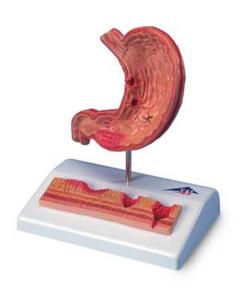 3B Scientific® Stomach With Ulcers