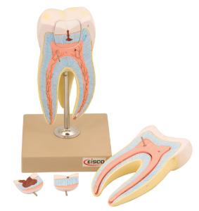 Eisco® Enlarged Upper Triple Root Molar Model, 6 Parts