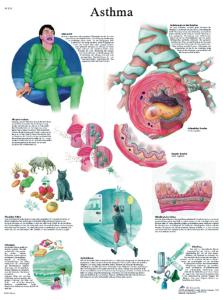 3B Scientific® Asthma Chart