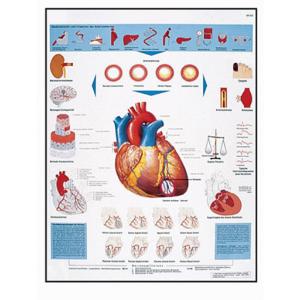 3B Scientific® Infarction Chart