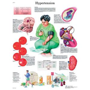 3B Scientific® Hypertension Chart