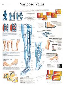 3B Scientific® Varicose Veins Chart