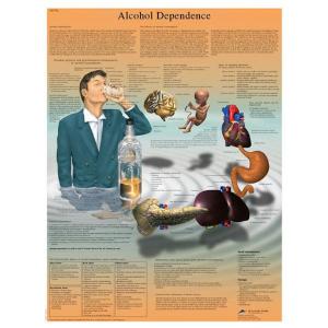 3B Scientific® Alcohol Dependence Chart