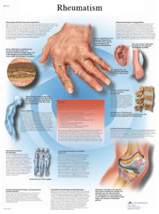 3B Scientific® Rheumatism Chart