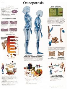 3B Scientific® Osteoporosis Chart