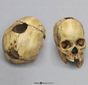 BoneClones® Human Female Skull with Shotgun Wounds