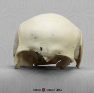 BoneClones® Human Female Partial Cranium with Shotgun Pellets Embedded