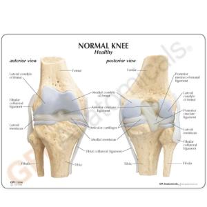 GPI Anatomicals® Stages of Osteoarthritis Knee Model