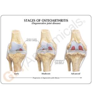 GPI Anatomicals® Stages of Osteoarthritis Knee Model