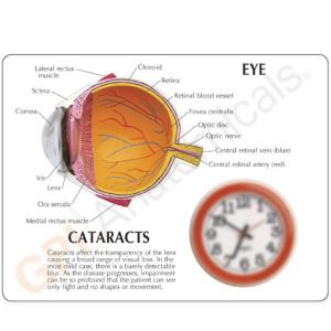 GPI Anatomicals® Cataract Eye Model