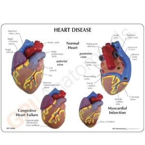 GPI Anatomicals® Heart Disease Model Set