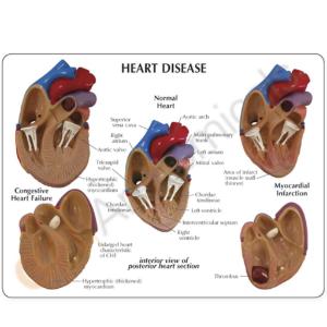 GPI Anatomicals® Heart Disease Model Set