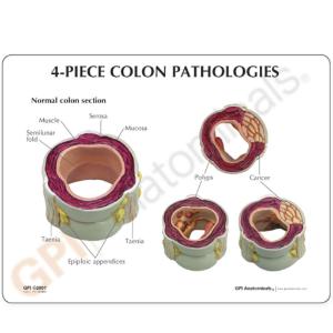 GPI Anatomicals® Colon Pathology Model