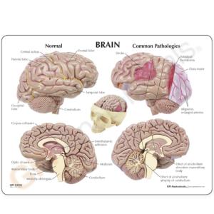GPI Anatomicals® Brain in Skull Pathologies Model