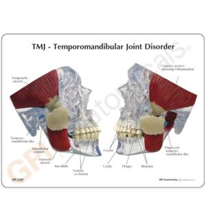 GPI Anatomicals® TMJ/Temporomandibular Model