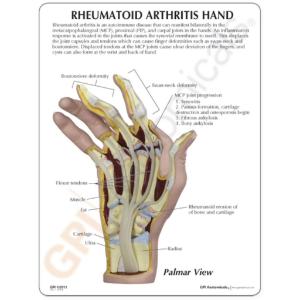 GPI Anatomicals® Rhumatoid Arthritis Hand