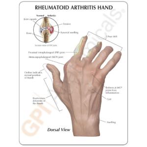 GPI Anatomicals® Rhumatoid Arthritis Hand Model