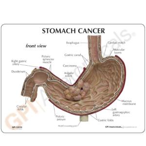 GPI Anatomicals® Stomach Cancer