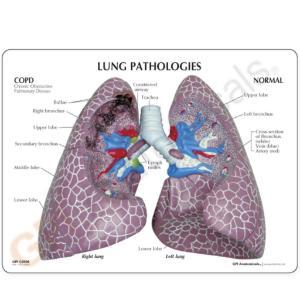 GPI Anatomicals® Lung Set with Pathologies
