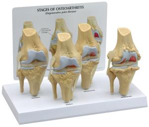 GPI Anatomicals® Stages of Osteoarthritis Knee Model