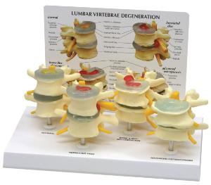 GPI Anatomicals® 4-Stage Vertebrae Model