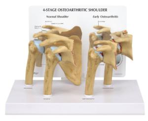 GPI Anatomicals® Osteoarthritis Stages