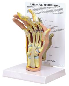 GPI Anatomicals® Rhumatoid Arthritis Hand Model