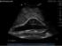 Abdominal aortic aneurysm µltrasound training model