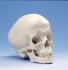 3B Scientific® Hydrocephalic Skull